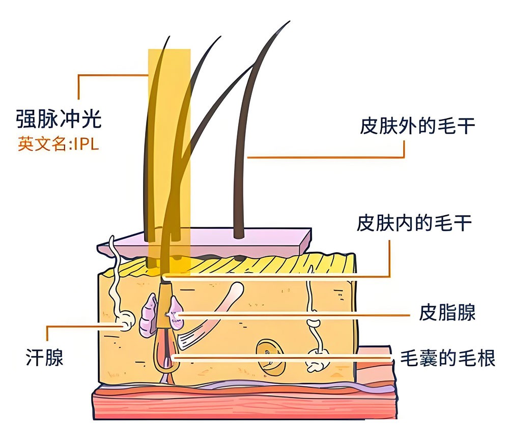 光子脫毛